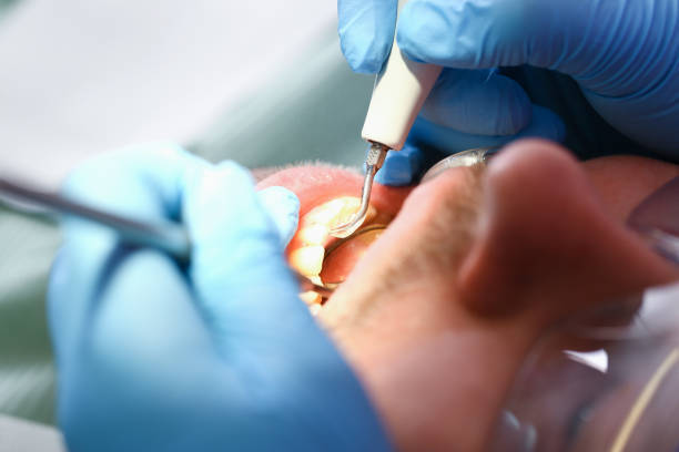 Best Emergency Wisdom Teeth Removal in Hudson, FL